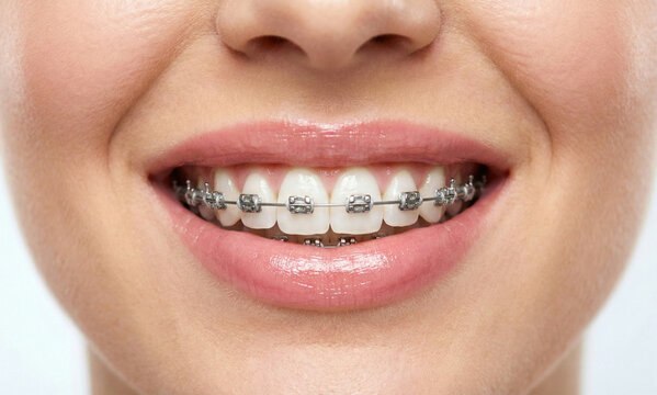 Beautiful Smile with Metal Dental Braces Close-up