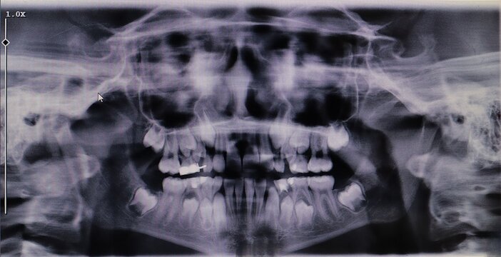 Panoramic dental X-ray of a 9-year-old child, showing pediatric dental space maintainer planning, primary and permanent teeth development, hidden wisdom tooth in the jaw.
