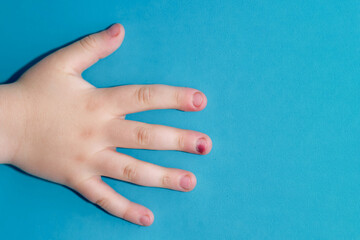 Child hand with a painful bruised finger, copy space. Health issue. Finger injury on blue background with copy space. Trauma on nail. Child aged 4 years (four years old)