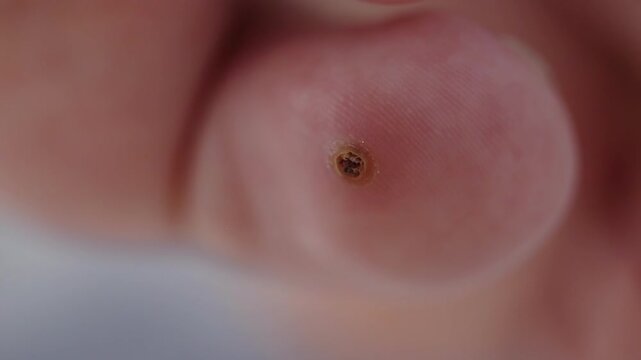 Close-up detail of plantar wart on human foot, showing circular lesion with dark center on toe underside
