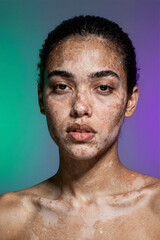 Portrait of a woman with vitiligo on colorful background