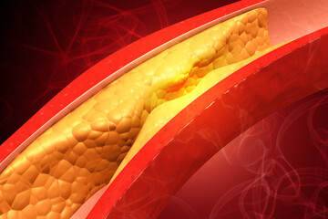 Clogged Coronary Artery. 3d Illustration