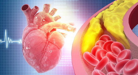 Atherosclerosis, Human Heart Anatomy with a Severely Blocked Coronary Artery due to Cholesterol Plaque Buildup. 3d illustration