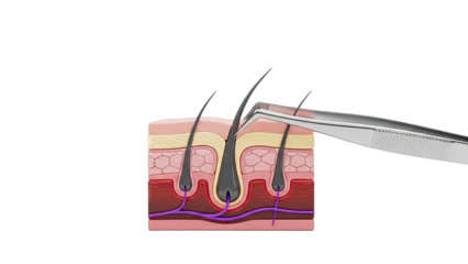 Close-up of tweezers removing hair from skin cross-section