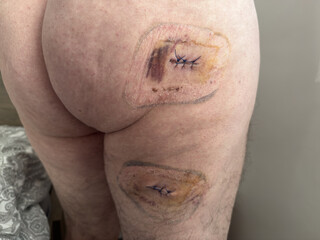 Fototapeta premium Surgical wound with stitches after medical operation, close up. leg