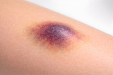Fototapeta premium Photorealistic 3D macro close-up of subcutaneous bruising (ecchymosis) on human forearm irregular bluish-purple discoloration with soft gradient edges, mild swelling optional