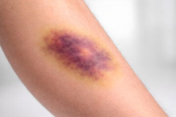 Fototapeta premium Photorealistic 3D macro close-up of subcutaneous bruising (ecchymosis) on human forearm irregular bluish-purple discoloration with soft gradient edges, mild swelling optional