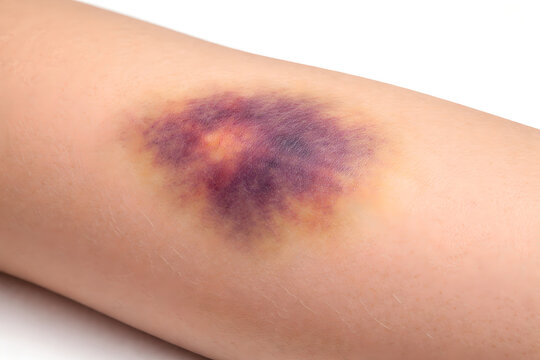 Photorealistic 3D macro close-up of subcutaneous bruising (ecchymosis) on human forearm irregular bluish-purple discoloration with soft gradient edges, mild swelling optional