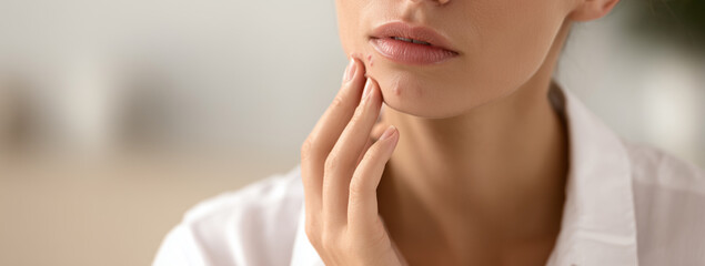 Close up of a young woman touching a pimple on her chin, dealing with skin problems and acne inflammation for dermatology treatment and skincare routine concept