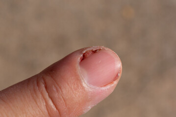 Acute Paronychia Infection on Fingernail Close-Up