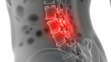 Medical illustration of a human lower back with a highlighted painful lumbar spine, depicting discomfort or injury
