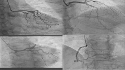 Coronary Angiogram shows RCA (Right coronary artery ) LAO view and LAD cranial, and caudal angulations.