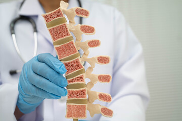 Doctor holding osteoporosis in back bone model for treatment medical in orthopedic department.
