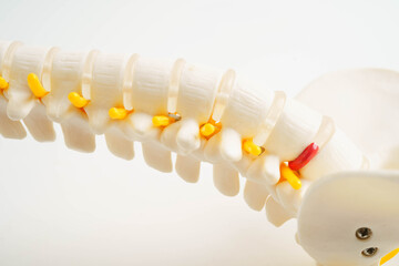 Spinal nerve and bone, Lumbar spine displaced herniated disc fragment, Model for treatment medical in the orthopedic department.