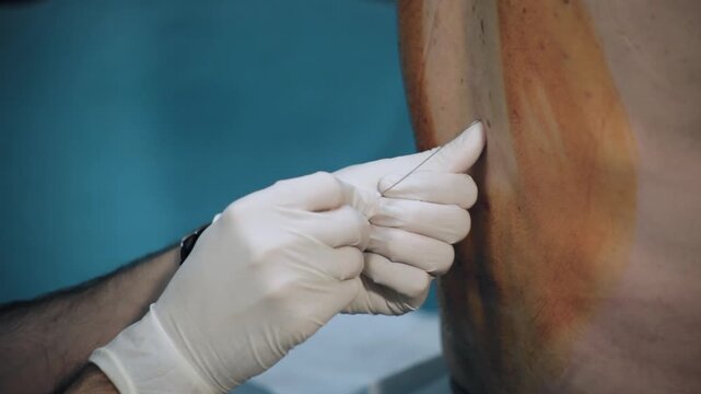 Anesthesiologist administering spinal anesthesia injection into patient's back, detail
