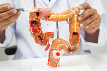Colorectal cancer, doctor holding intestine colon human anatomy model.