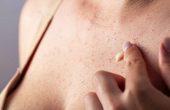 A girl smears red pimples on her body skin with healing ointment after dermatological irritation, close-up