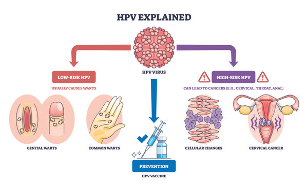 HPV explained overview illustrates virus types, vaccine syringe, and cervix, showing how low-risk cause warts and high-risk lead to cancer, with prevention guidance. Outline diagram