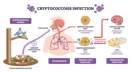 Cryptococcosis infection overview shows airborne yeast inhaled from soil to lungs, spreading via bloodstream to brain and skin, key objects, lungs, brain, yeast. Diagram © VectorMine
