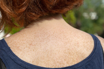 Close-up of freckles on shoulder and upper back of fair-skinned red-haired woman