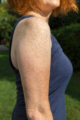 Side view of freckled arm and shoulder of fair-skinned red-haired woman