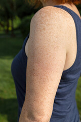 Side view of freckled arm and shoulder of fair-skinned red-haired woman