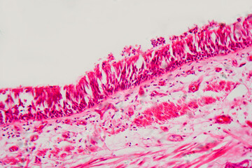 Photomicrograph of bronchial epithelial squamous metaplasia
