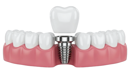 Dental Implant Procedure Illustration