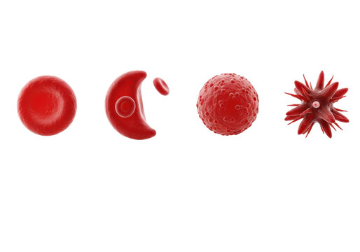 five volumetric 3d renderings of human red blood cell pathologies (sickle cell, spherocyte, acanthocyte, schistocyte) and a healthy disc, isolated on a clinical white background with labels and