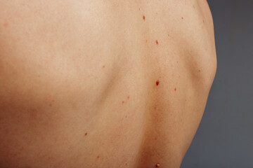 moles and age spots on the back of a young man. men's health: skin cancer and dermatological diseases. moles close-up