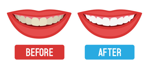 Teeth whitening. Before and after. Vector flat illustration.