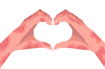 Two hands with skin issues making a heart gesture isolated on white background. Skin rash, psoriasis, dermatitis or eczema. Vector Not AI generated