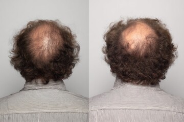 Transformation of hair loss viewed from behind shows striking contrast in fullness and texture with curly locks and balding patches