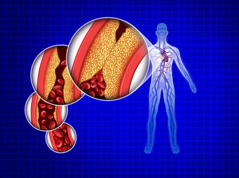 Blocked Human Cardiovascular Circulation and atherosclerosis as a heart attack and blockage in the arteries anatomy from a healthy body on a blue background as a medical healthcare symbol of an inner 