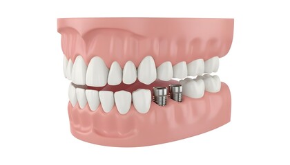 Obraz premium Dental implants structure in human jaw, 3D medical illustration of tooth restoration process with metal screw and abutment inside gums, professional stomatology and oral hygiene concept.