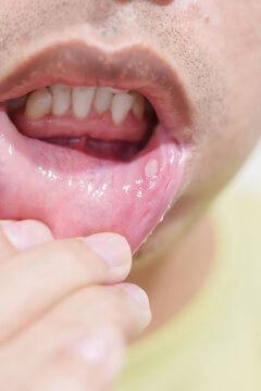 Mouth Ulcer Sore or Aphthous Stomatitis. Oral Health and Medical concepts
