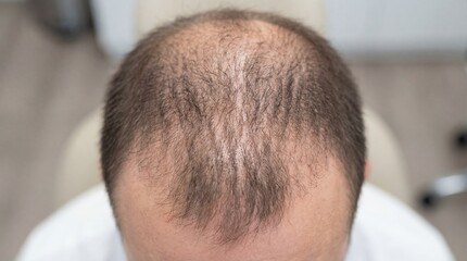 Macro photograph from top-down of a person&rsquo;s head showing thinning hair with scalp slightly visible. Neutral indoor background softly blurred, highlighting hair density and natural texture.