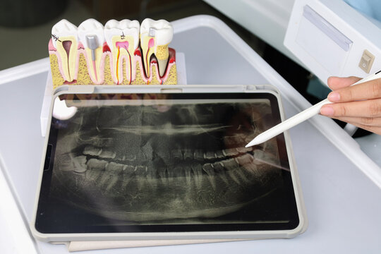 Dentist pointing at a digital panoramic X-ray on a tablet screen, highlighting an impacted wisdom tooth. Dental anatomy model in the background.