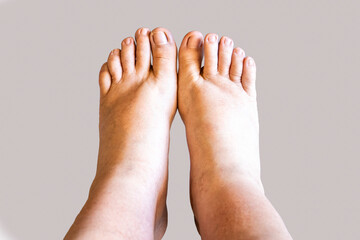 Close-up of a swollen foot and ankle showing edema, a symptom of fluid retention. Represents a medical condition, injury, or health problem related to the circulatory or lymphatic system.