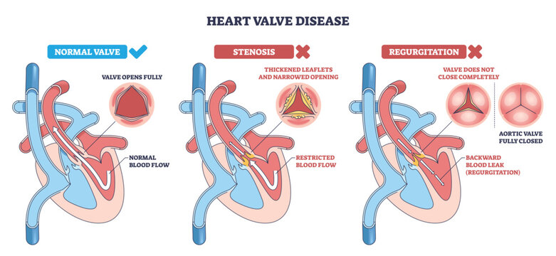 Heart valve disease diagram compares normal, stenosis, and regurgitation, shows heart, aortic valve, and blood flow arrows to explain function and defects. Outline diagram