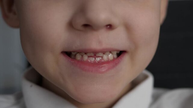 A close-up of the smile of a child whose teeth are falling out and new ones are starting to grow.