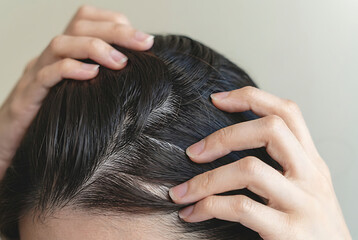 Woman Scratching Scalp with Visible Dandruff Flakes.