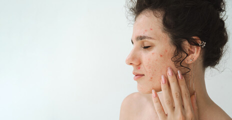 face of a young girl with pimples and red acne close-up on a white background. A woman with problematic skin with copy space