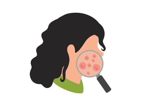 Acne Papula in Face Skin Illustration