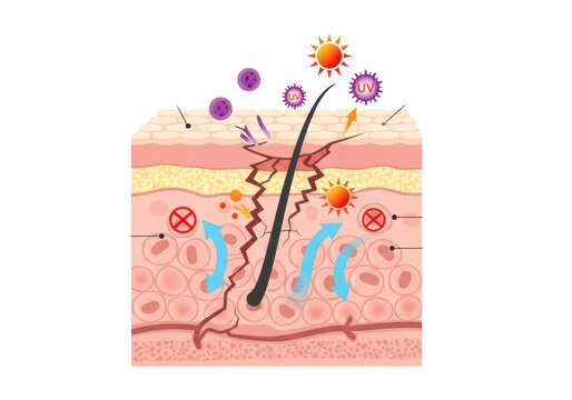 highly detailed color-coded 2d vector schematic of the human epidermis showing compromised stratum corneum, penetrating bacteria, moisture loss (tewl), and japanese labels. concept of dermatological