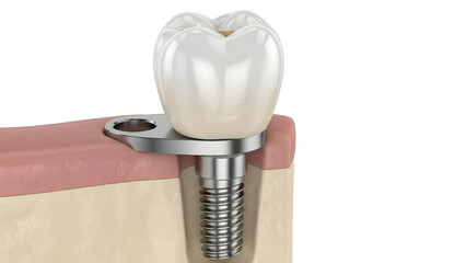 Dental Implant: a detailed look at a dental implant, highlighting its structure, with a focus on dental health and dental care. 