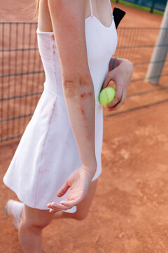 Tennis player with scraped arms after match on clay court