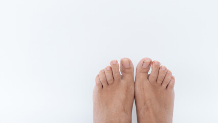 Close-up of bare feet showing signs of nail infection on toes, with soft white background...
