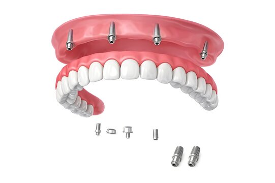 All-on-4 dental implant system with full arch prosthesis and abutments, 3D rendering.