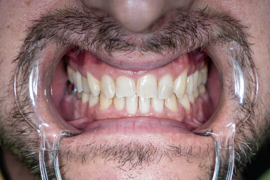 Teeth of a man. The mouth is wide open with retractors, the teeth are visible up close.